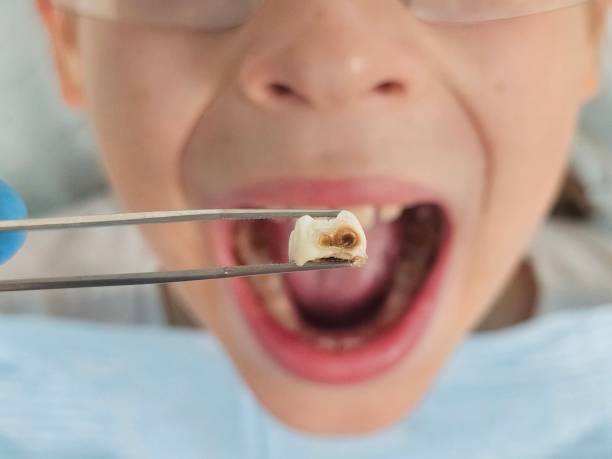 Best Emergency Wisdom Teeth Removal in Oliver Springs, TN